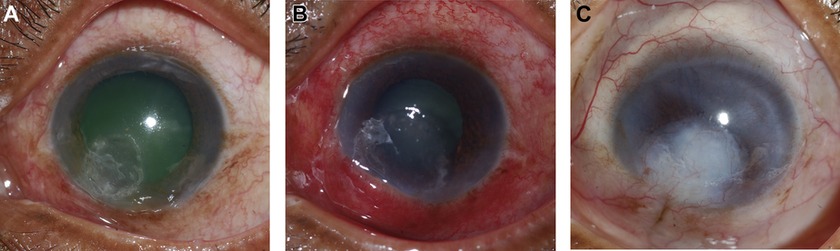 Corneal Ectasia and Keratoconus