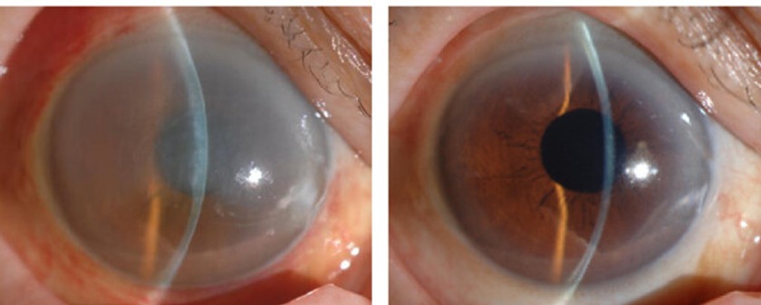 Corneal Dystrophy
