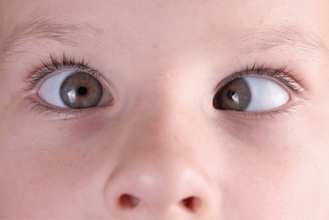 Squint and Amblyopia