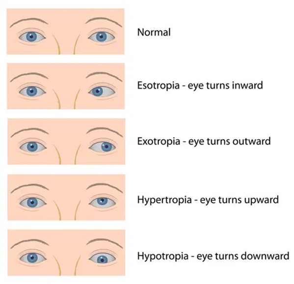 Medical Treatment for Squint
