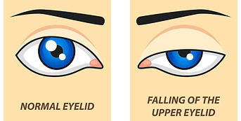 Oculoplasty Treatment
