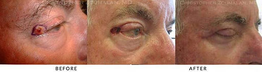 Blepharoplasty