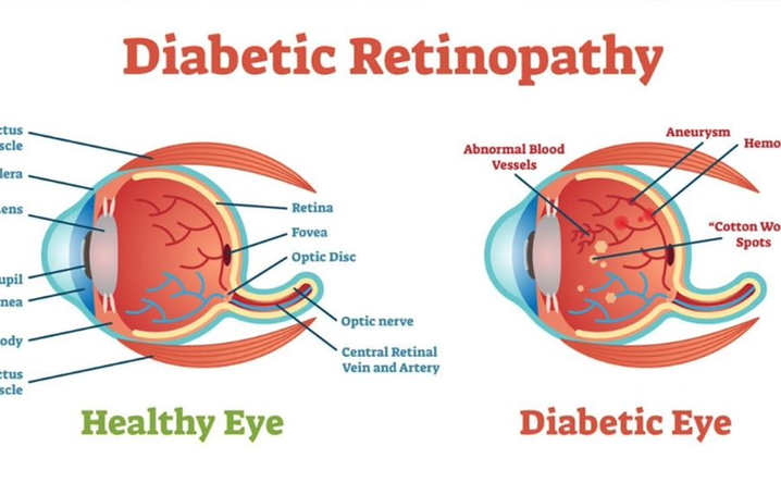 Diabetic Retinopathy