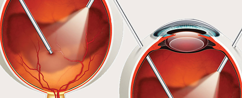 Vitrectomy Surgery